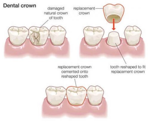 why-crowns-the-tribeca-dentist